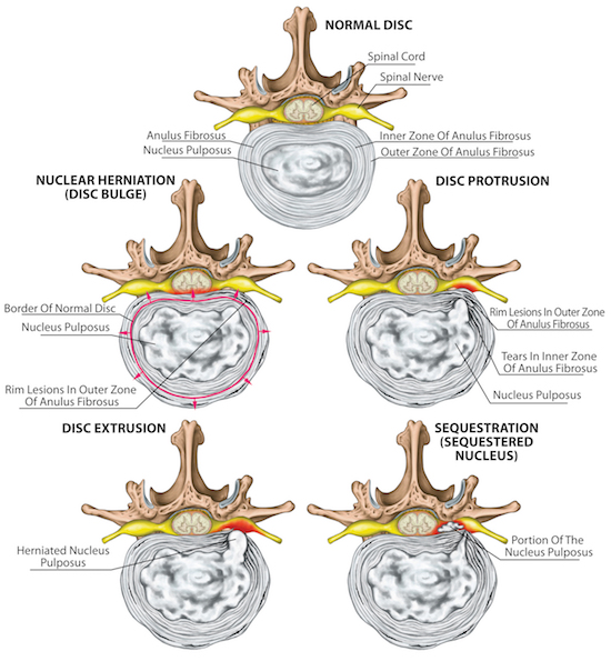 Disk herniation
